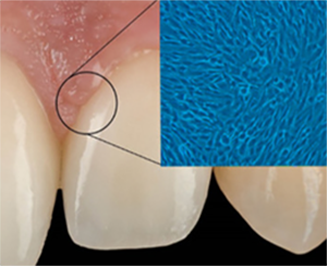 Identifying a New Treatment for Periodontitis